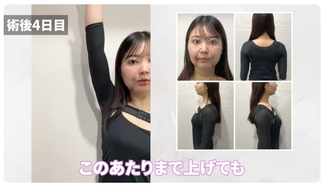 湘南美容 脂肪吸引 上腕 圧迫ボレロ 2着セット アミュレット Sサイズ  