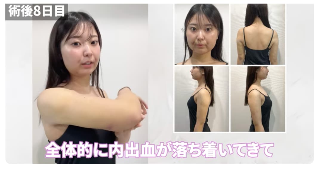 脂肪吸引ダウンタイム特集・二の腕編】後悔しない/ビフォーアフター 
