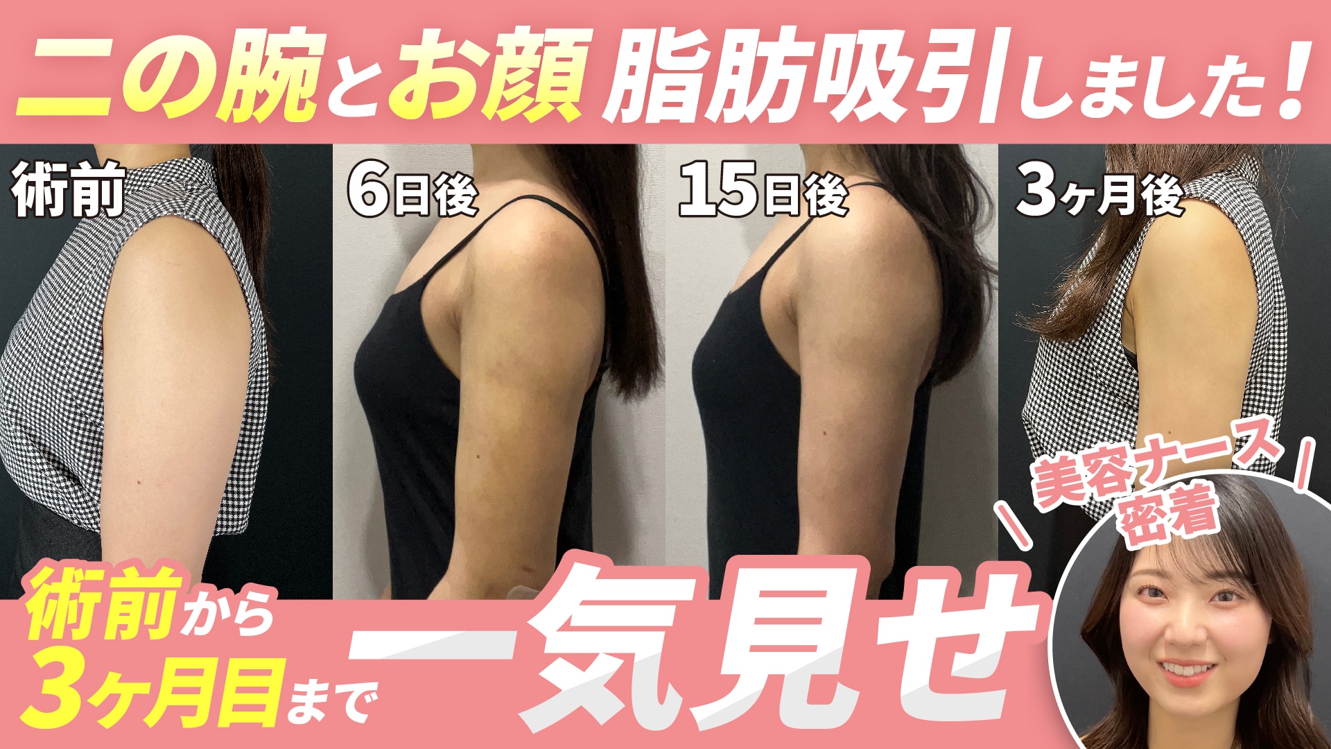 脂肪吸引圧迫着3点セット (ボレロ・ガードル・ウエストニッパー  