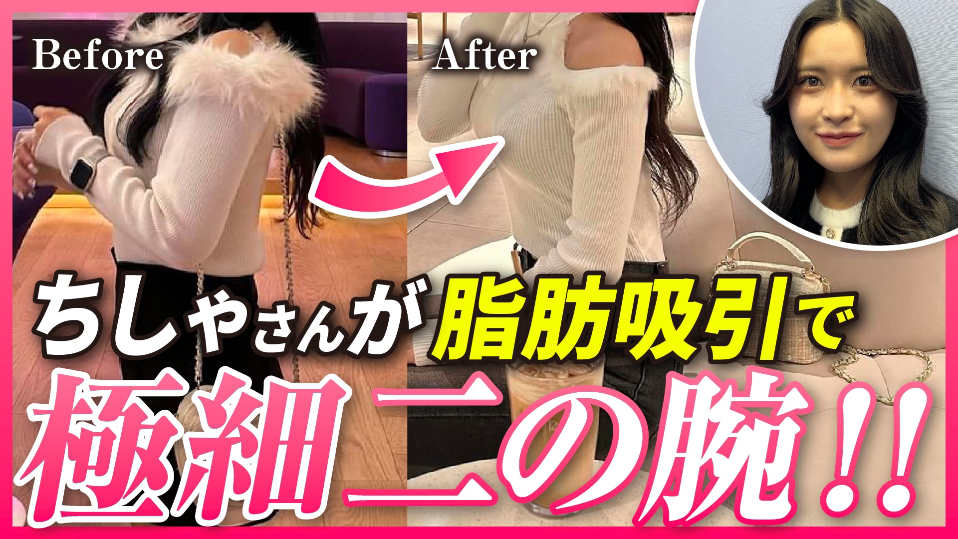 【二の腕|肩|背中脂肪吸引】どうして脂肪吸引を選びましたか？振袖たぷたぷ|ダイエットが難しい【湘南美容クリニック・新橋銀座口院】