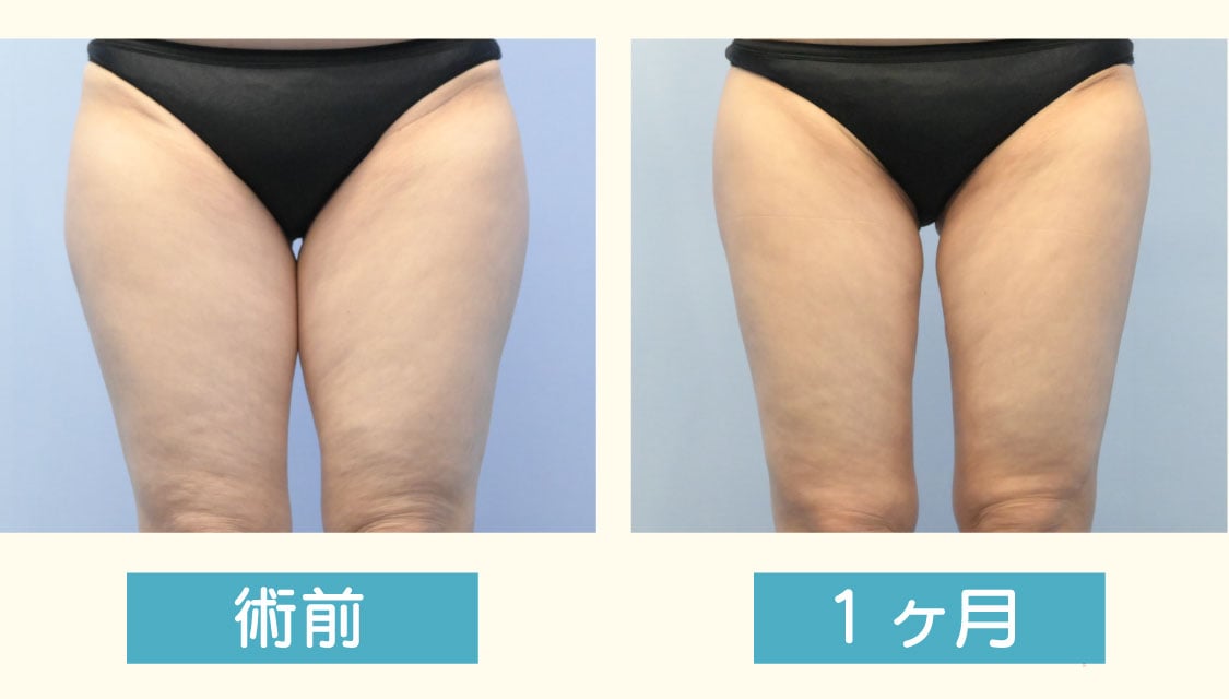 内もも・張り出しをキレイに解消