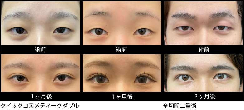 二重術