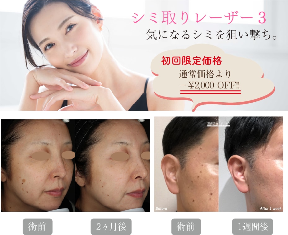 【1万円以下】シミ取りレーザー3