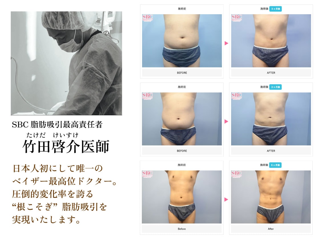 脂肪吸引