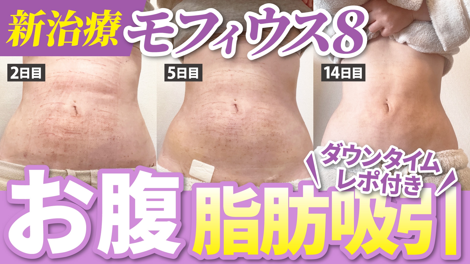 【たるみ対策の最終兵器】脂肪吸引後のたるみ、モフィウス8で引き締めませんか？