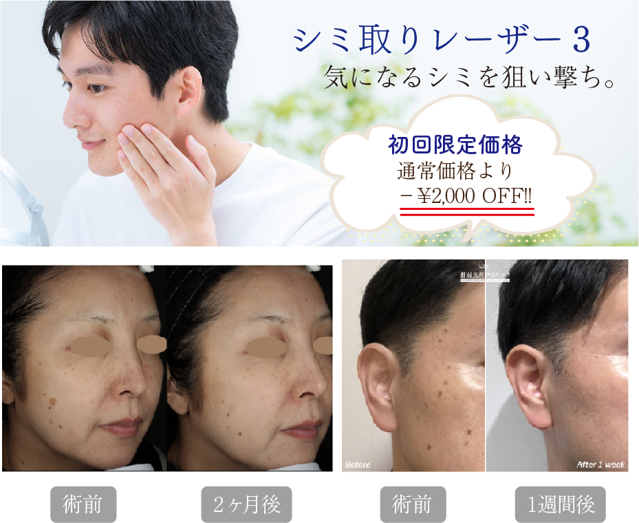 【1万円以下】シミ取りレーザー3
