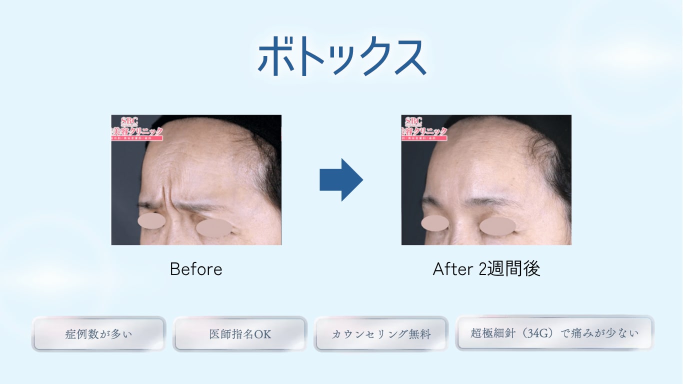 ボトックス注射
