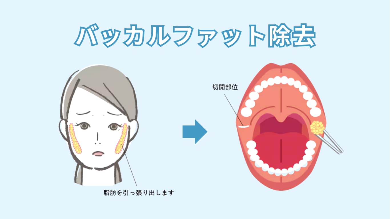 バッカルファット除去