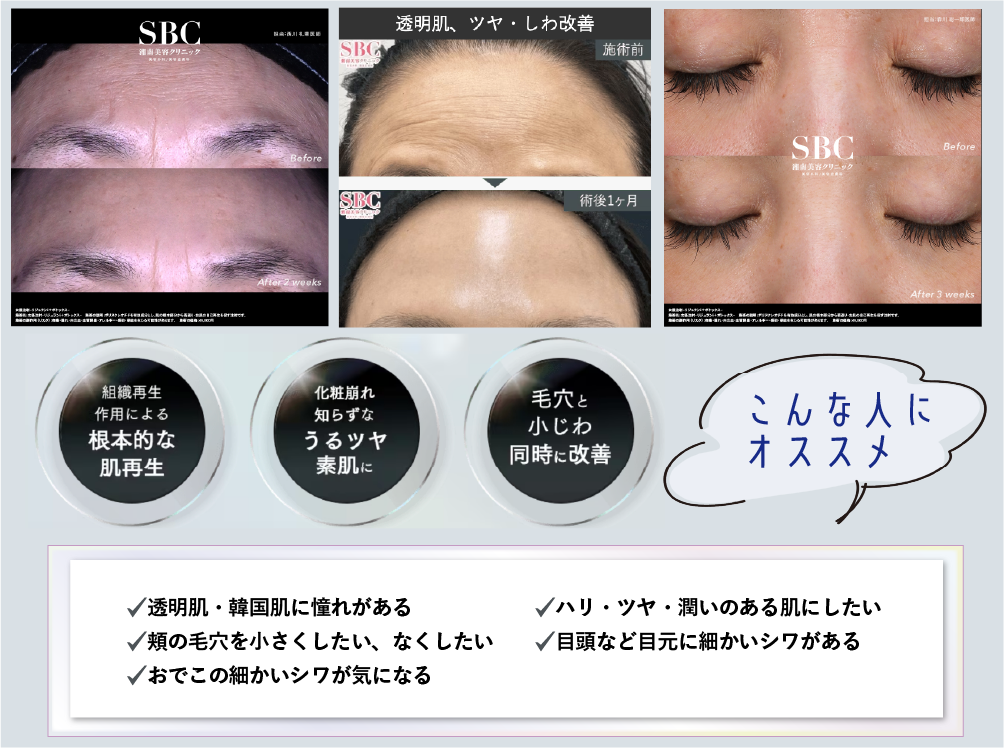 透明肌を目指す肌育注射