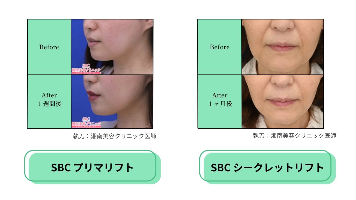 切らずに即日リフトアップ