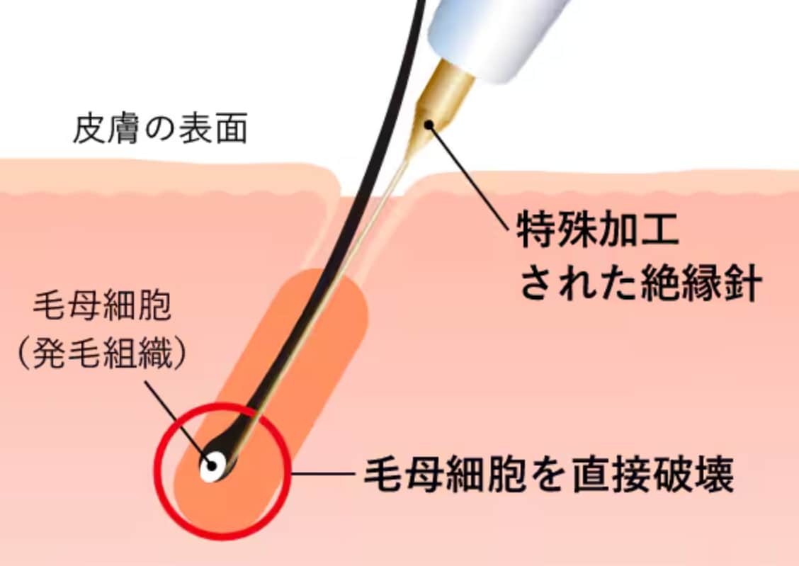 1本1本の毛を狙って毛母細胞(発毛組織)を直接破壊