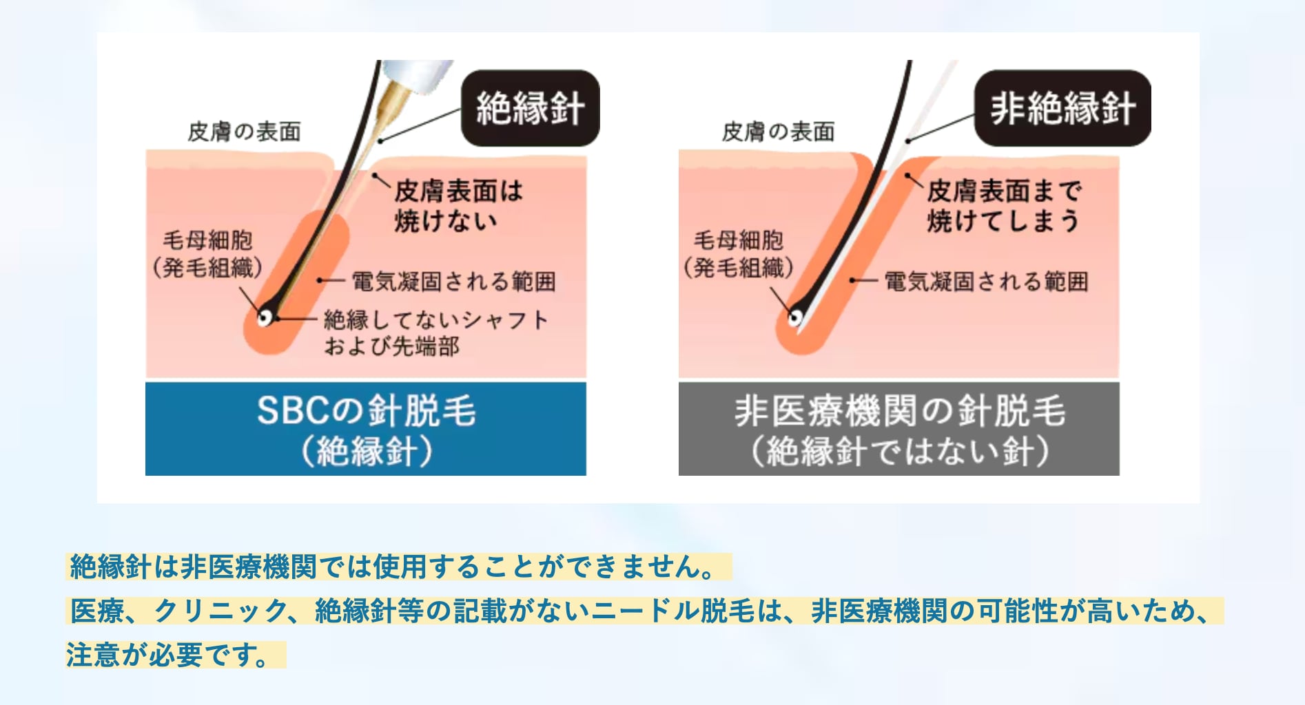 特殊加工コーティングされた医療用の針🪡