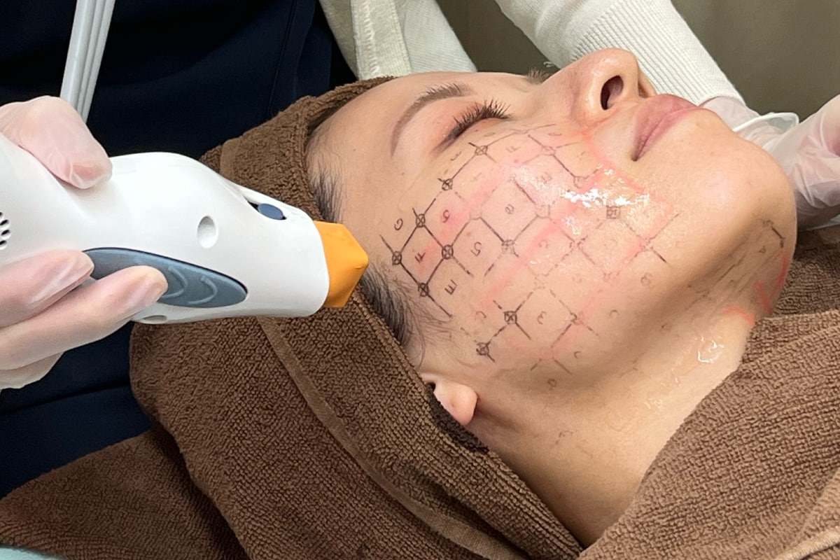 お肌のたるみやシワを高周波(ＲＦ)で改善する高周波たるみ治療