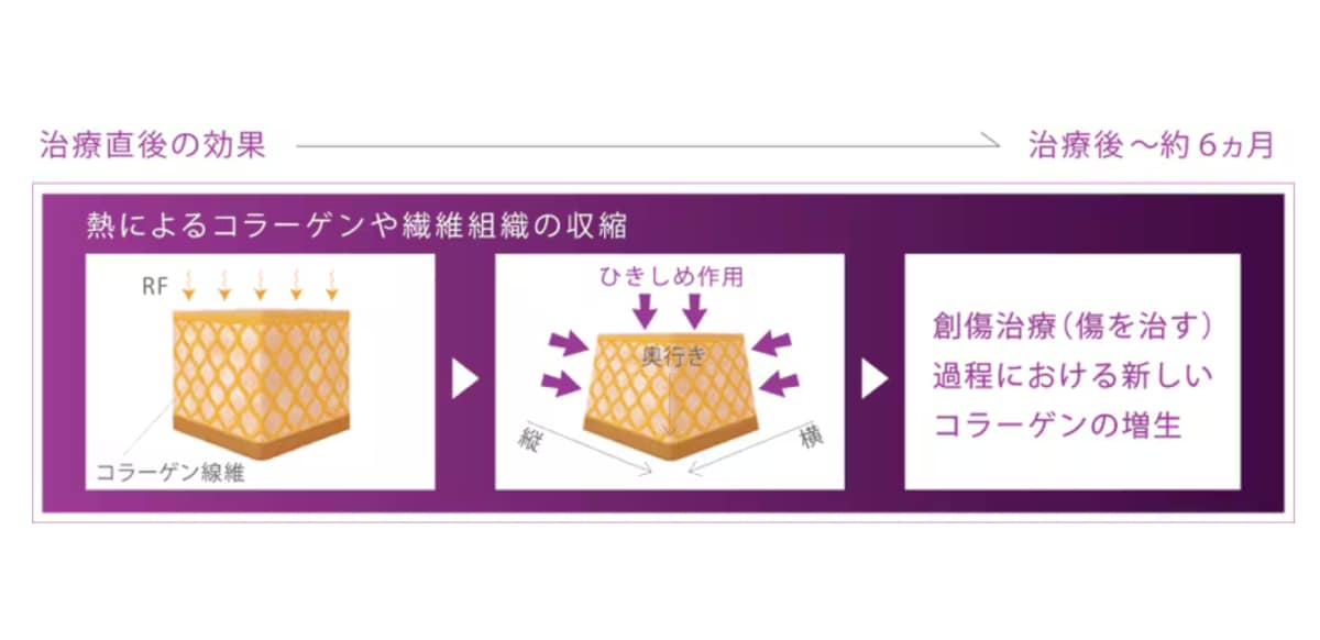 創傷治癒過程でおこるコラーゲンが新しく入れ替わる効果