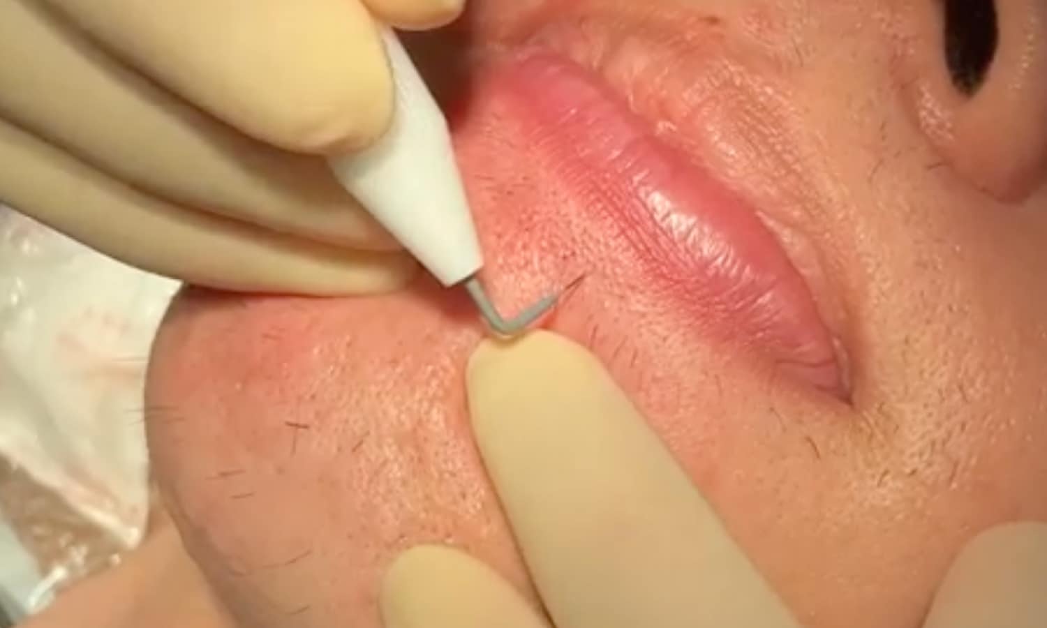 男性もニードル脱毛施術可能ですか？