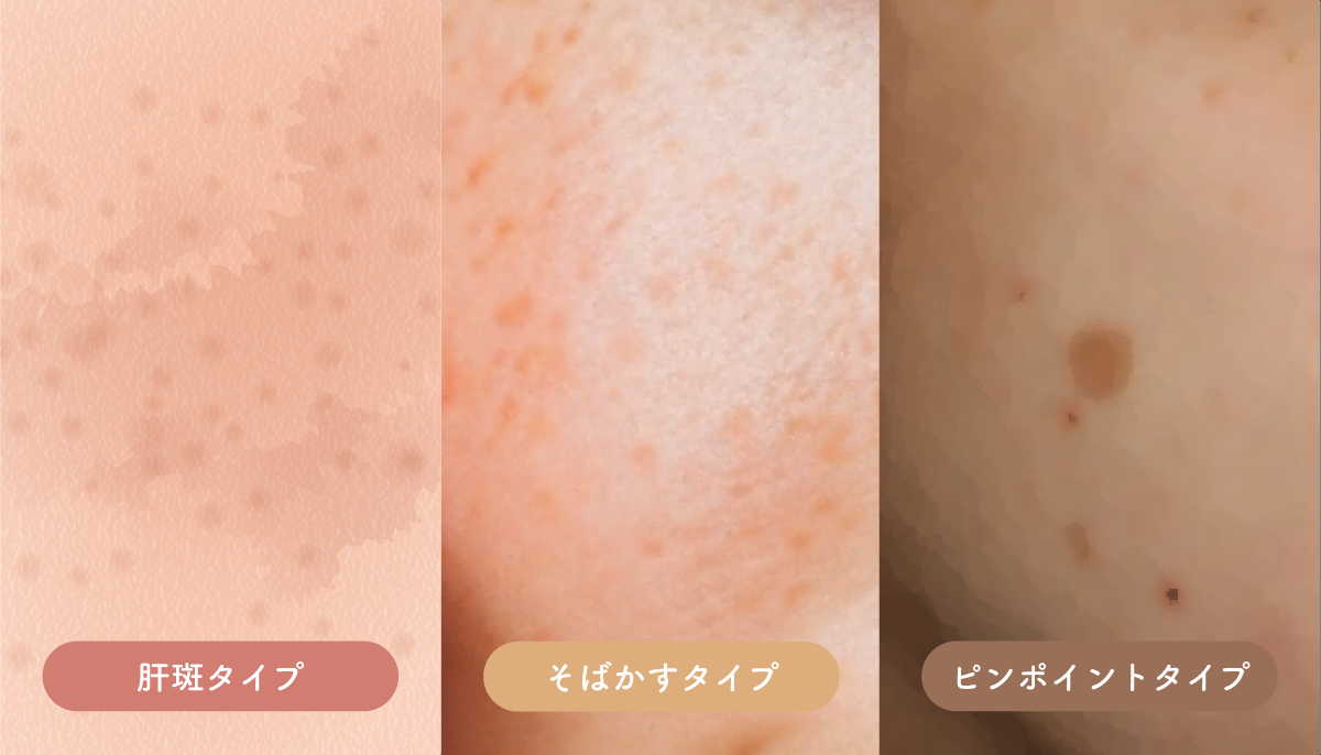 シミと言っても、その種類や濃さは人それぞれ。<br />
まずは自分のシミタイプを知って、最適な治療法を見つけることが大切です。