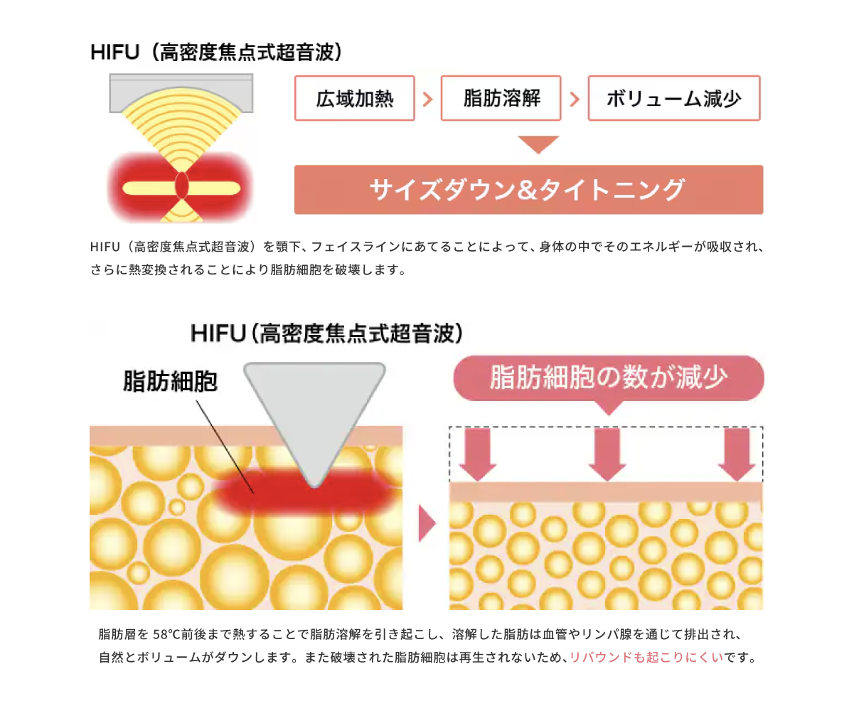 プリマリフト6本 ×脂肪溶解リニアHIFU（300ショット）