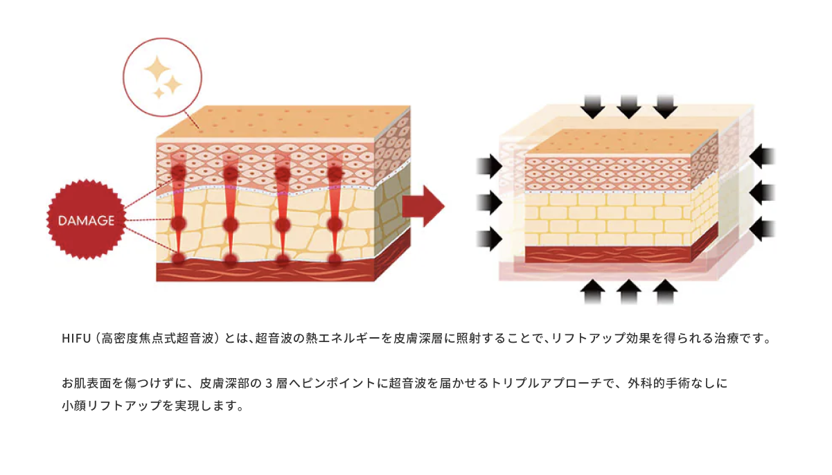 プリマリフト（6本） × ウルトラリフトプラスHIFU（あご下・目元含む全顔 650ショット）