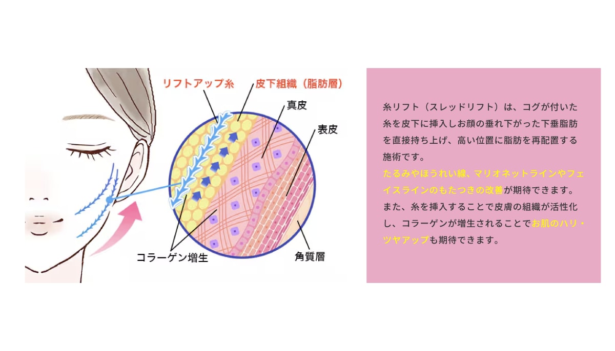 糸リフトってどんな治療？