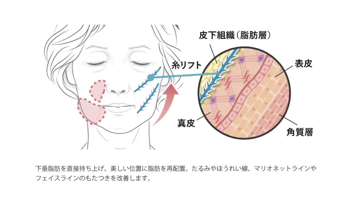 糸リフトはリフトアップ効果だけじゃない！？