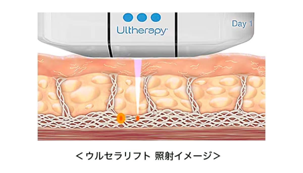 【違い①】ウルセラはエコー画面を見ながら「狙った深さに確実に照射」可能⭕️<br />
