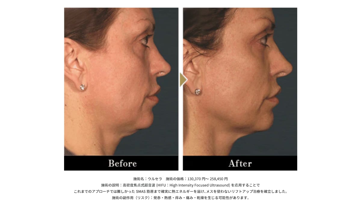 【違い②】美容皮膚科の最上級治療とも称されるたるみ治療マシン