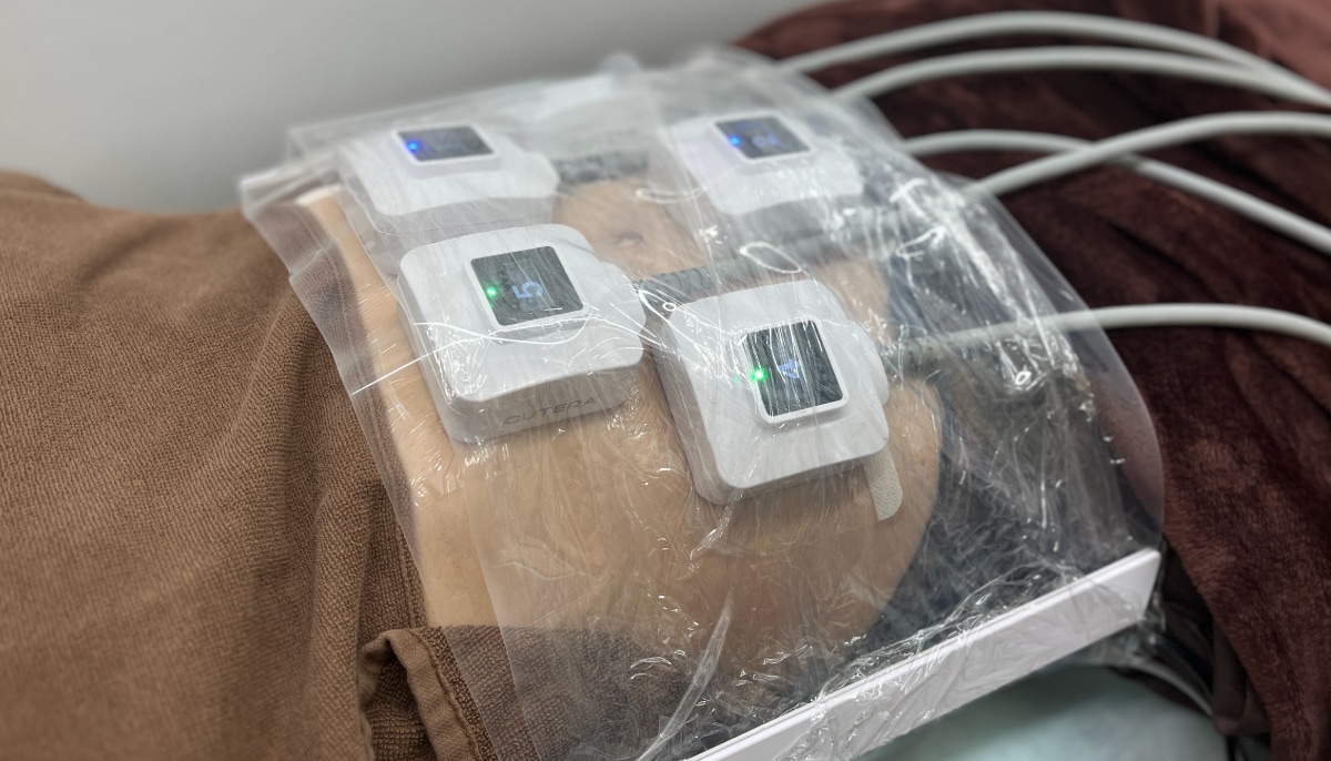 高周波（RF）を用いて脂肪細胞を加熱・破壊します🔥
