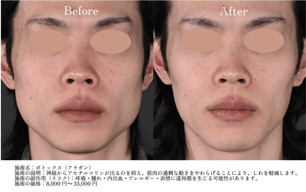 エラ症例ビフォーアフター