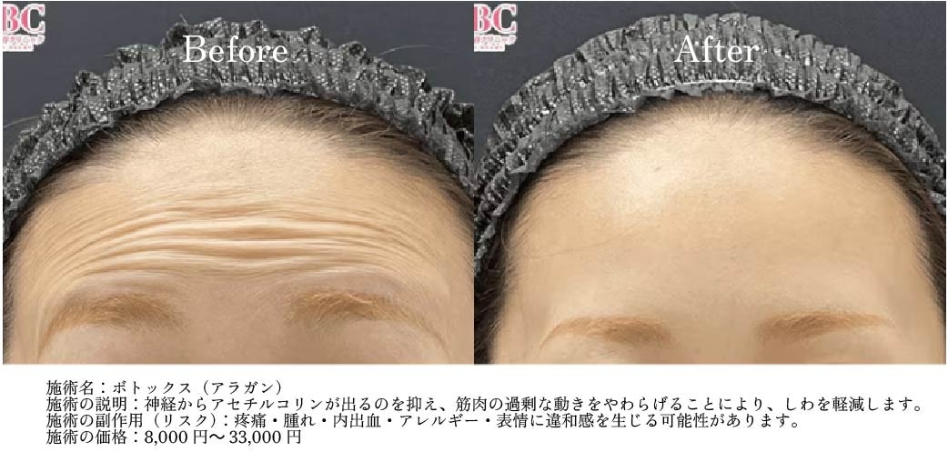 額・眉間症例ビフォーアフター