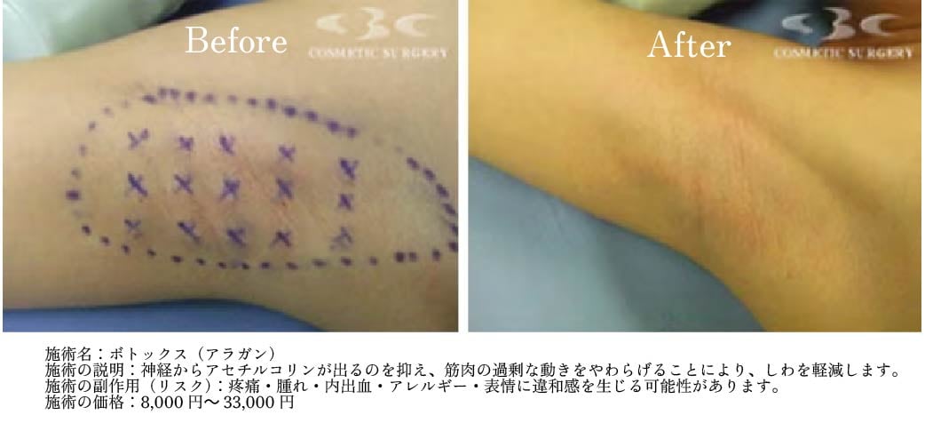 脇症例イメージ