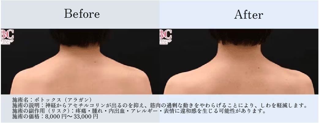 肩症例ビフォーアフター