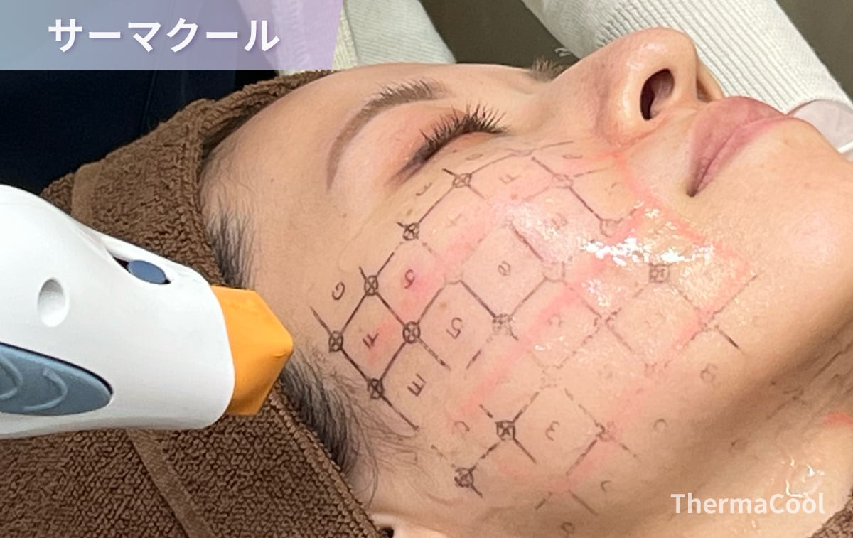 脂肪吸引後の定期メンテナンス・サーマクールイメージ
