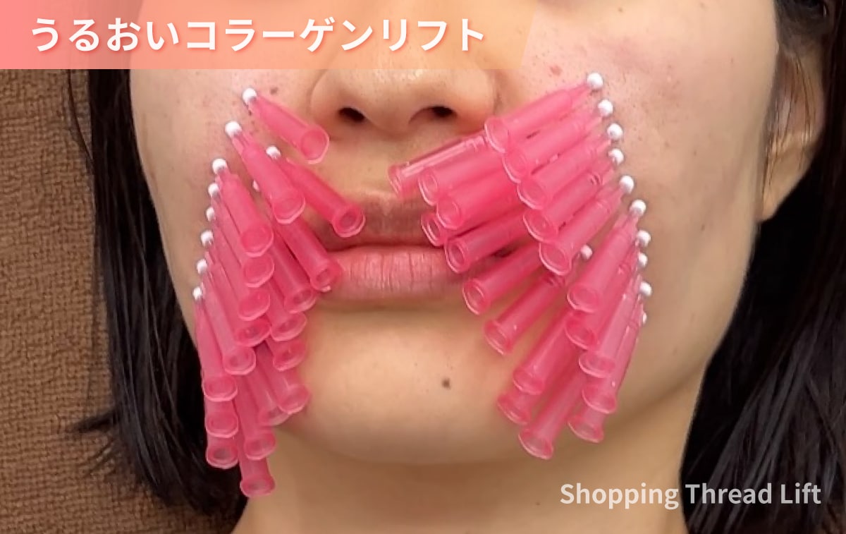 顎下脂肪吸引後のうるおいコラーゲンリフトによるアフターケアイメージ