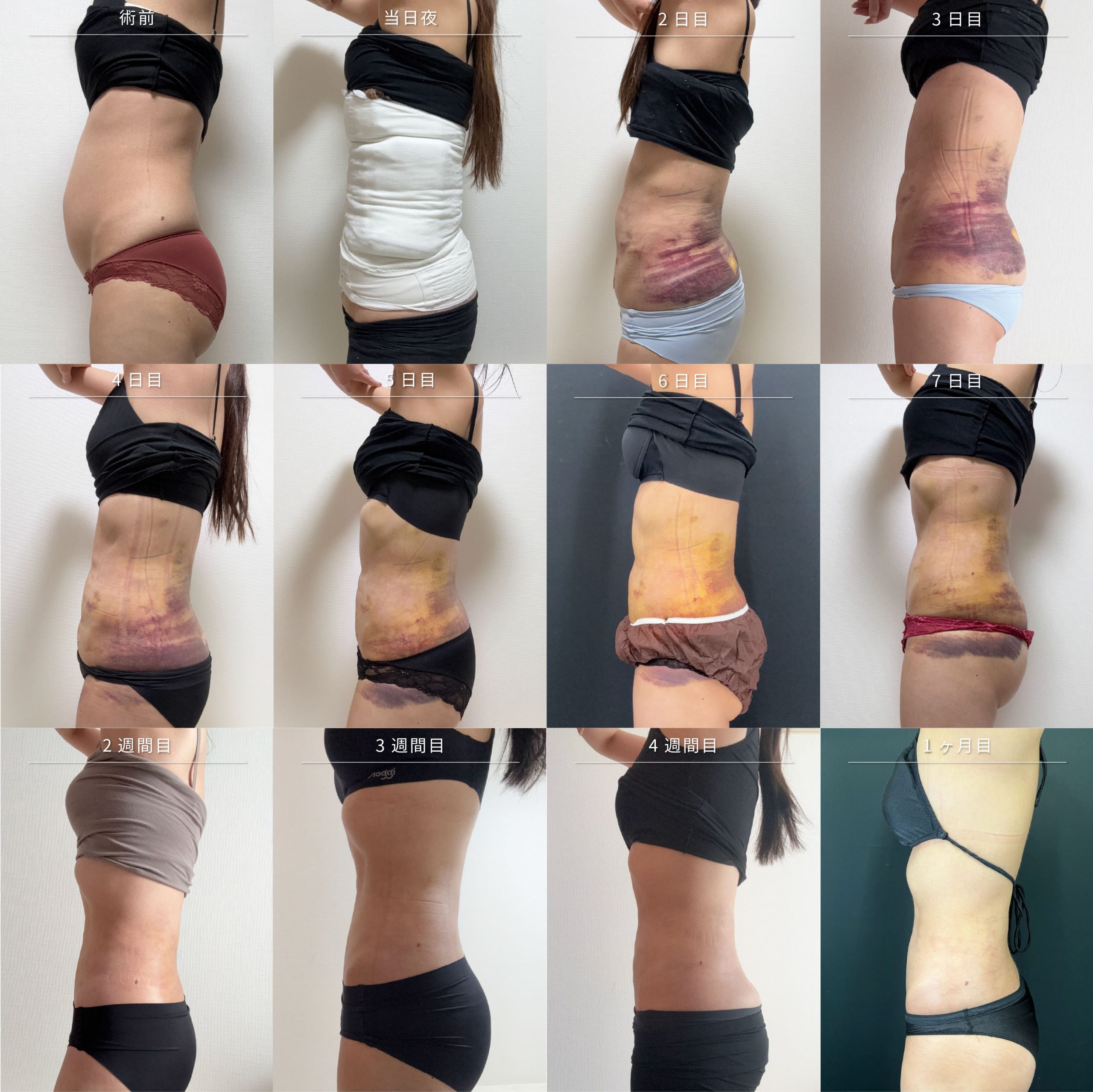 脂肪吸引ダウンタイム1ヶ月経過