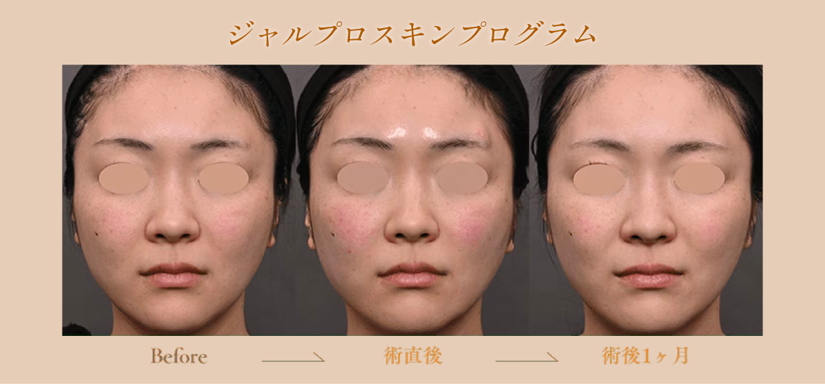 ジャルプロスキンプログラム
