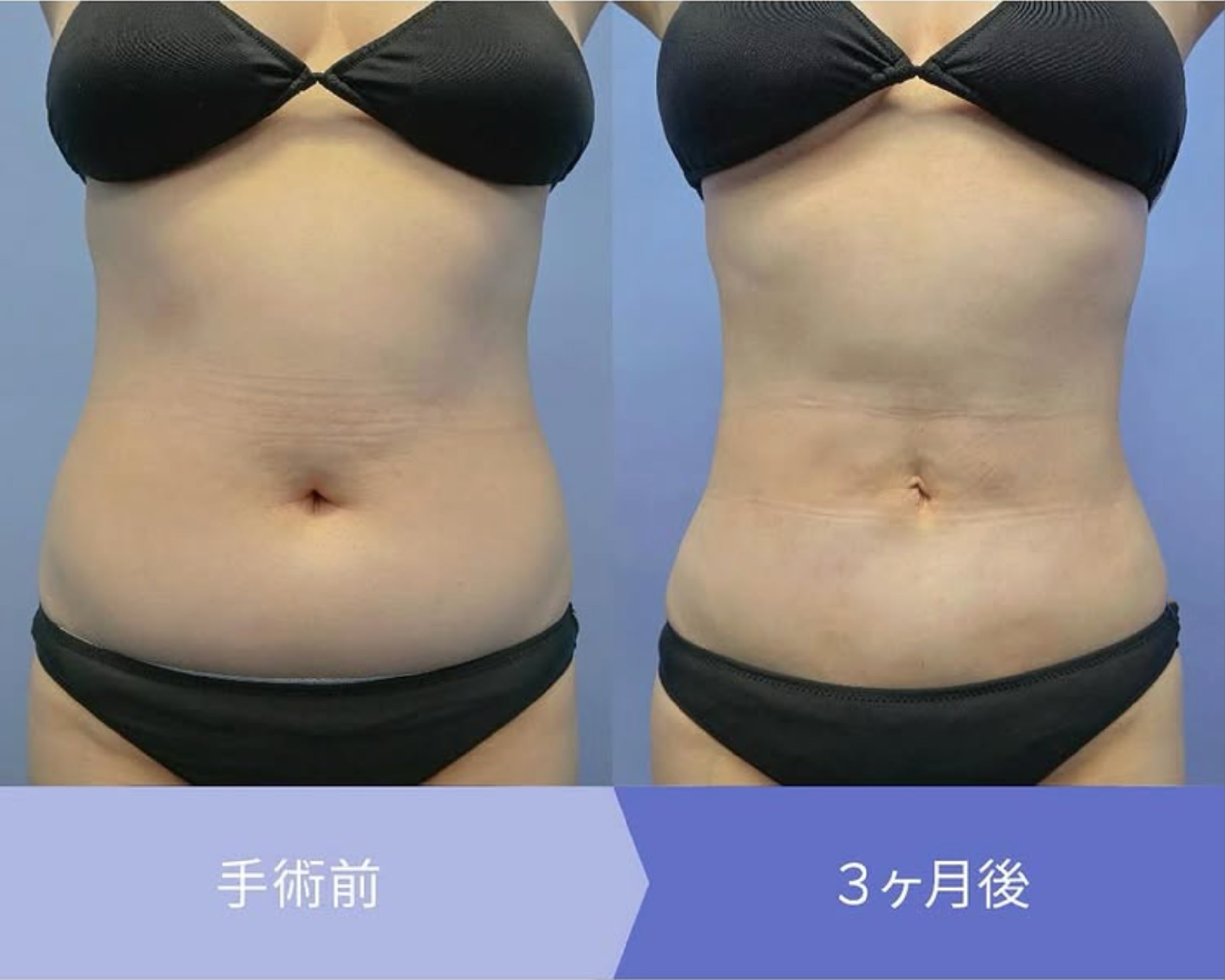 腹部脂肪吸引症例1