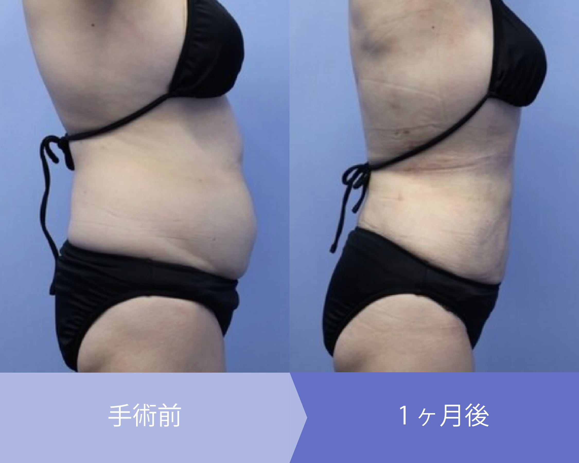 腹部脂肪吸引症例2