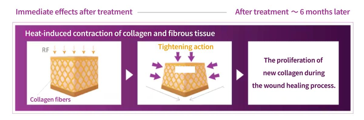The effect of collagen remodeling and regeneration that occurs during the natural wound healing process