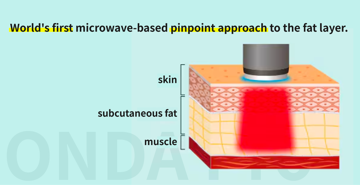 World's first microwave-based approach to pinpoint fat layer targeting
