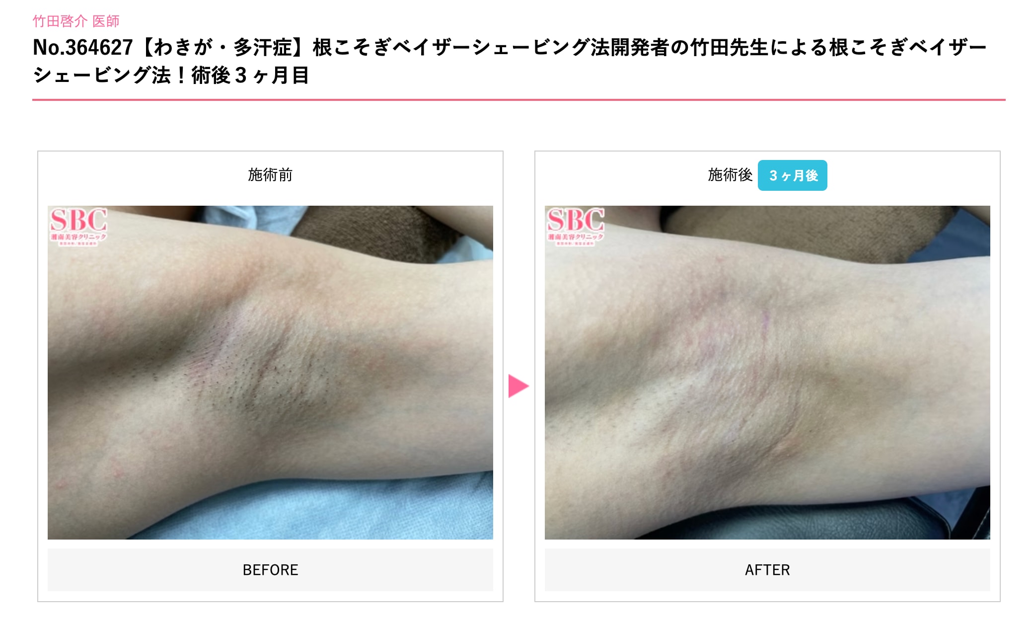 = ワキガの救世主 = 根こそぎベイザーシェービング