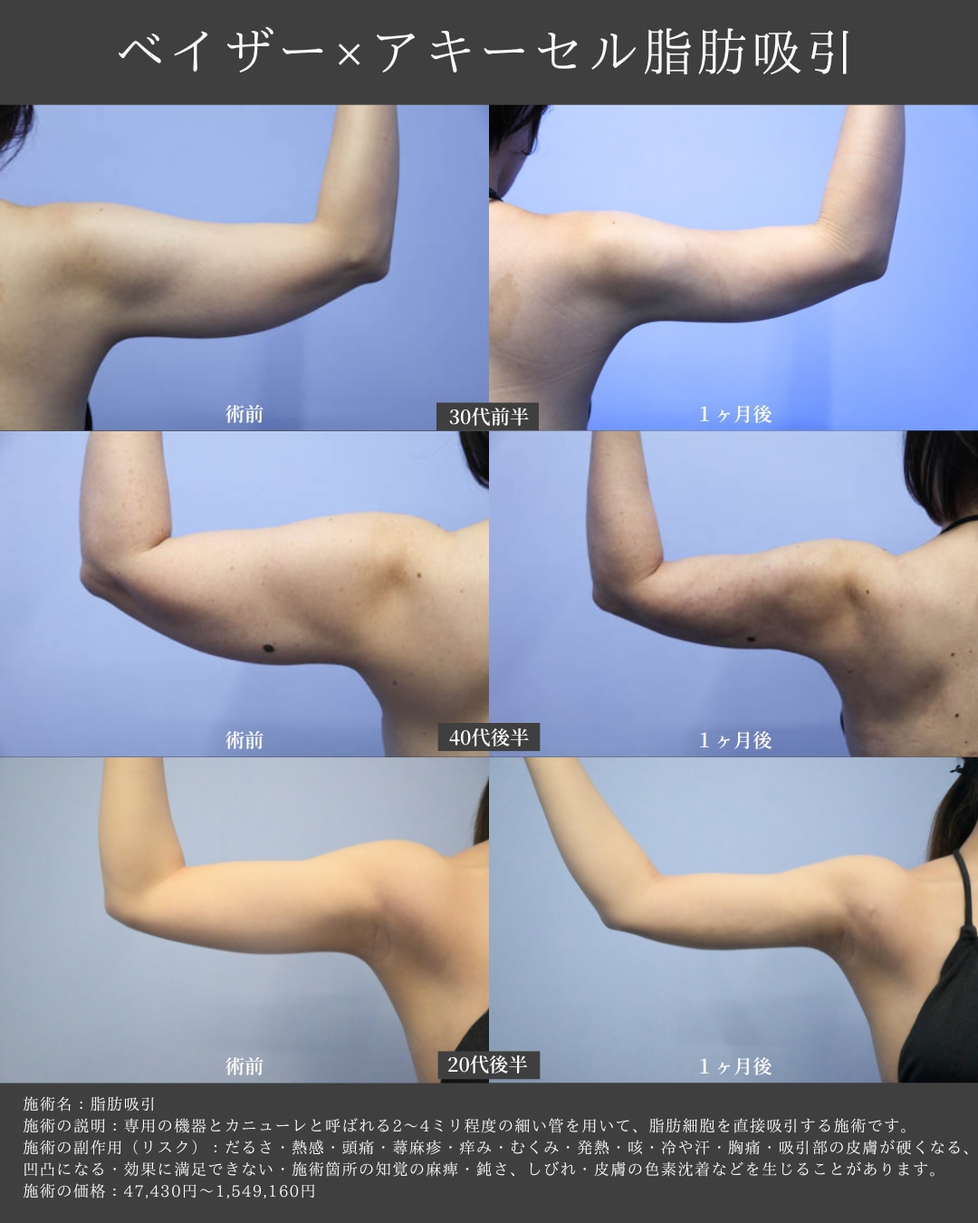 二の腕の脂肪吸引💪