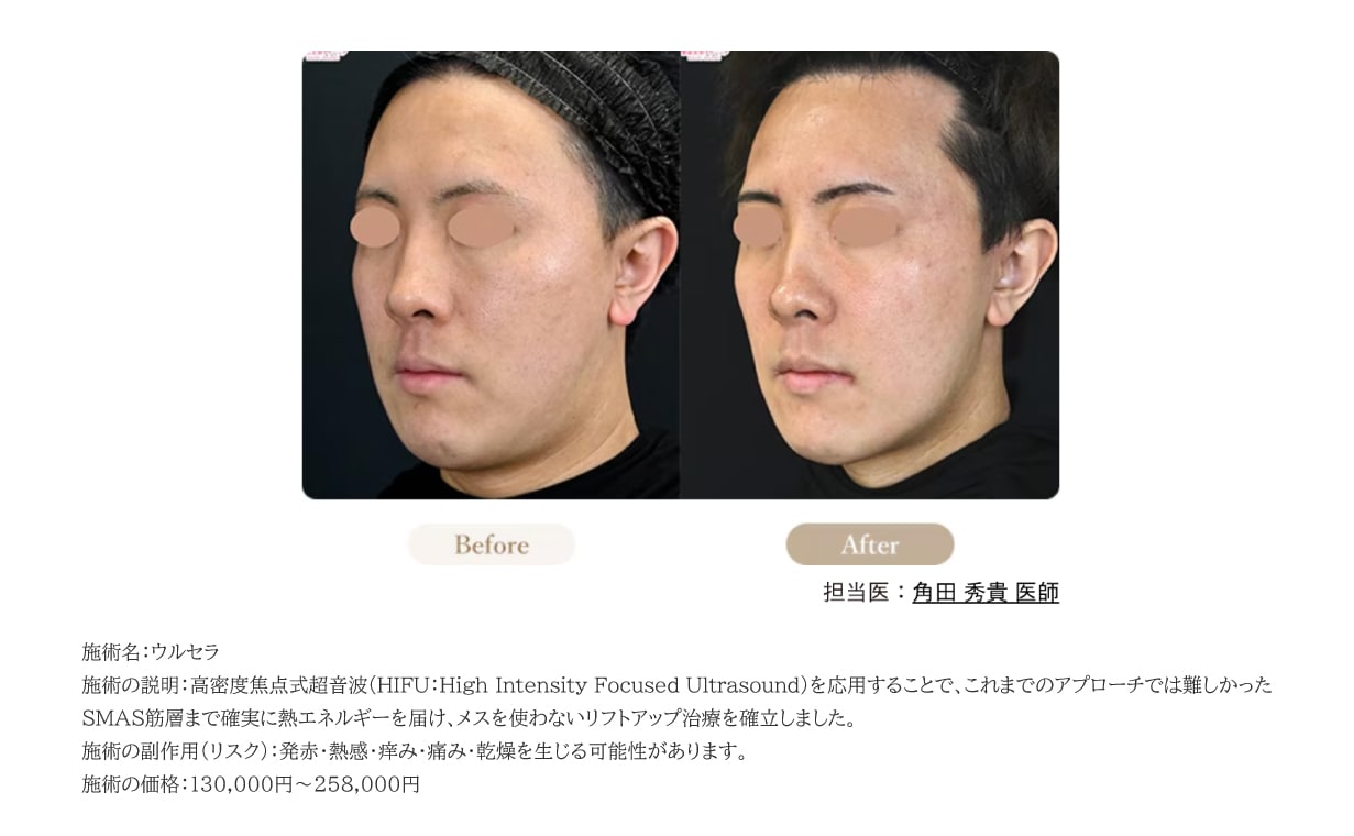 症例写真ウルセラプライムトリプル