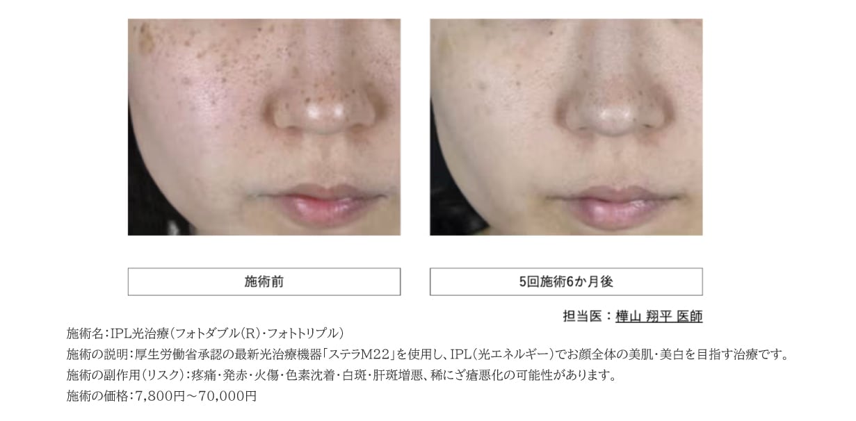 そばかすやくすみも気になるという方には「IPL光治療」