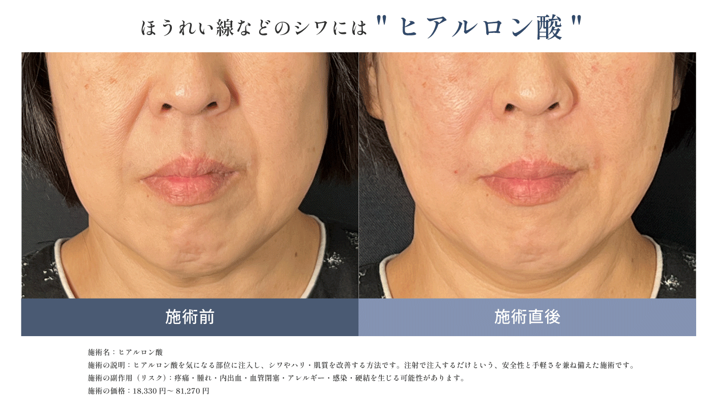 くっきり刻まれているほうれい線などのシワには"ヒアルロン酸"