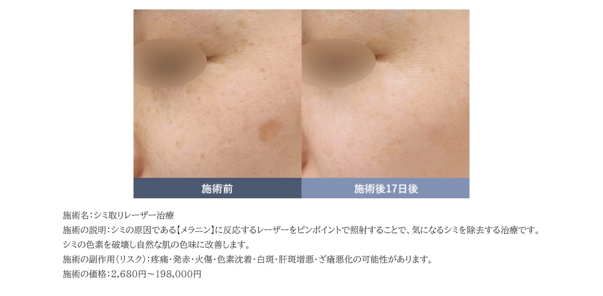 目立つシミには「シミ取りレーザー・ピコスポット照射」