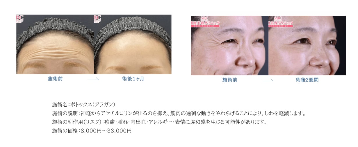 表情を動かす筋肉の発達を抑制し、しわを軽減 "ボトックス注射"
