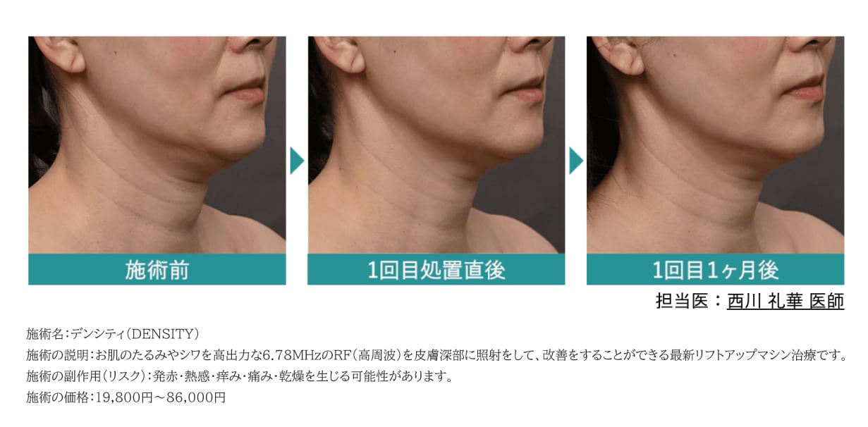 たるみ改善と肌質改善を同時に！最新リフトアップなら"高周波機器デンシティ"