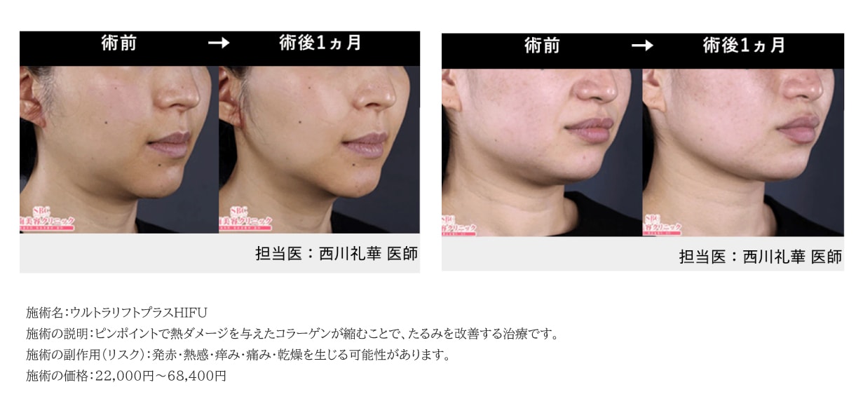 初めてのたるみケアにはコレ！医療ハイフ
