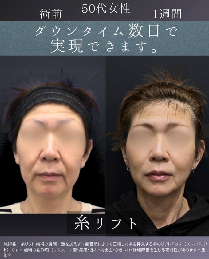 得意施術:輪郭の引き上げ・中顔面・ほうれい線のたるみ改善