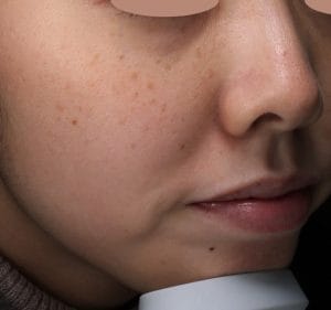 19,800円で顔中のシミを取りたい方は予約！